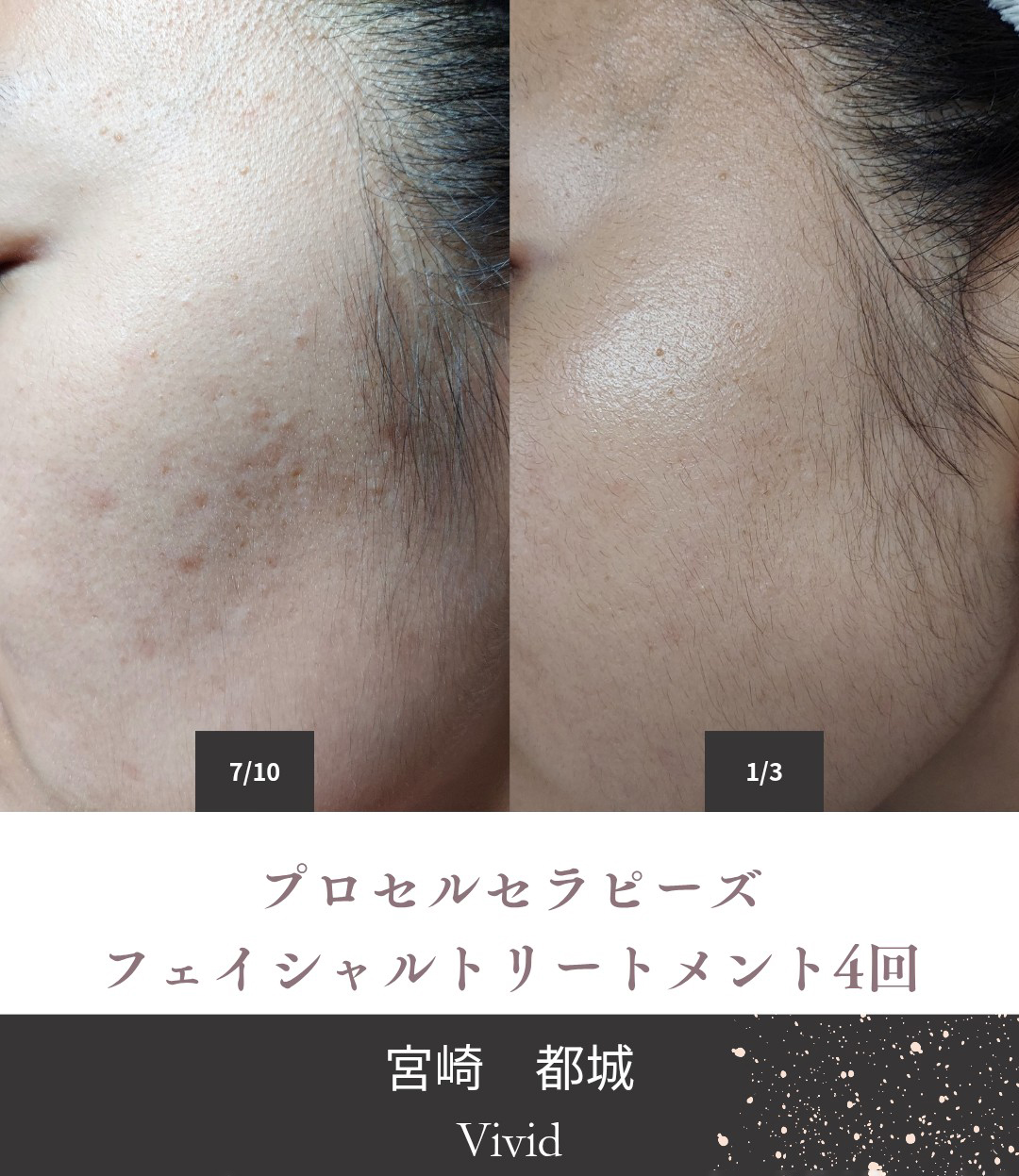 肌質改善トリートメント