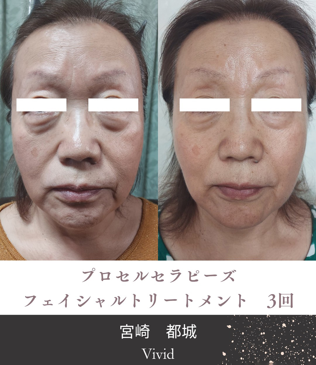 肌質改善トリートメント