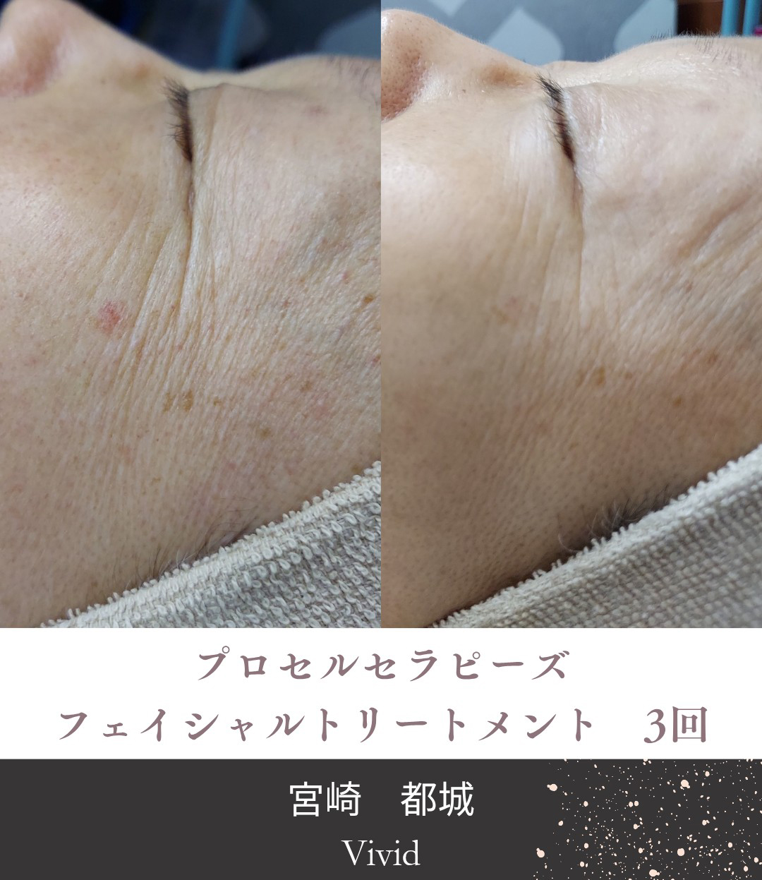 肌質改善トリートメント