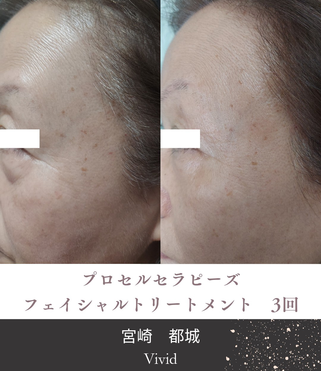 肌質改善トリートメント